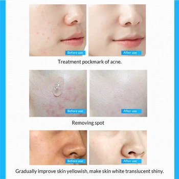 OMY LADY 10pcs Hialuronska Kislina Izvirne rešitve, facial serum anti-aging globoko vlažilne proti gubam, za nego kože bistvo obraz