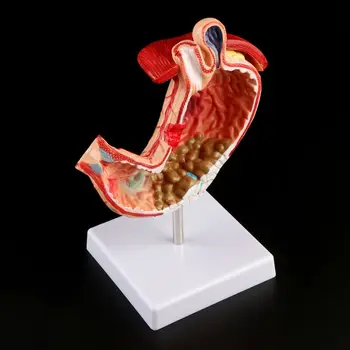 Človekove Anatomski Anatomija Želodec Medicinski Model Želodca, Patologija Gastritis Razjede Medicinske Poučevanja, Učno Orodje