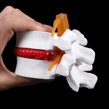 Človekove Anatomski Ledvenega Diska Herniation Model Medicinske Naučijo Pomoči, Anatomijo Instrume