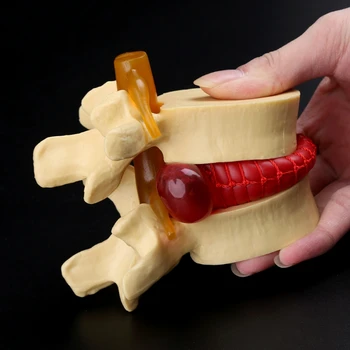 Anatomski Ledvene Hrbtenice Disk Herniation Anatomija učni pripomoček G6DD