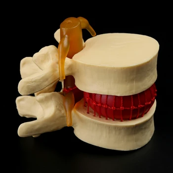 Anatomski Ledvene Hrbtenice Disk Herniation Anatomija učni pripomoček G6DD